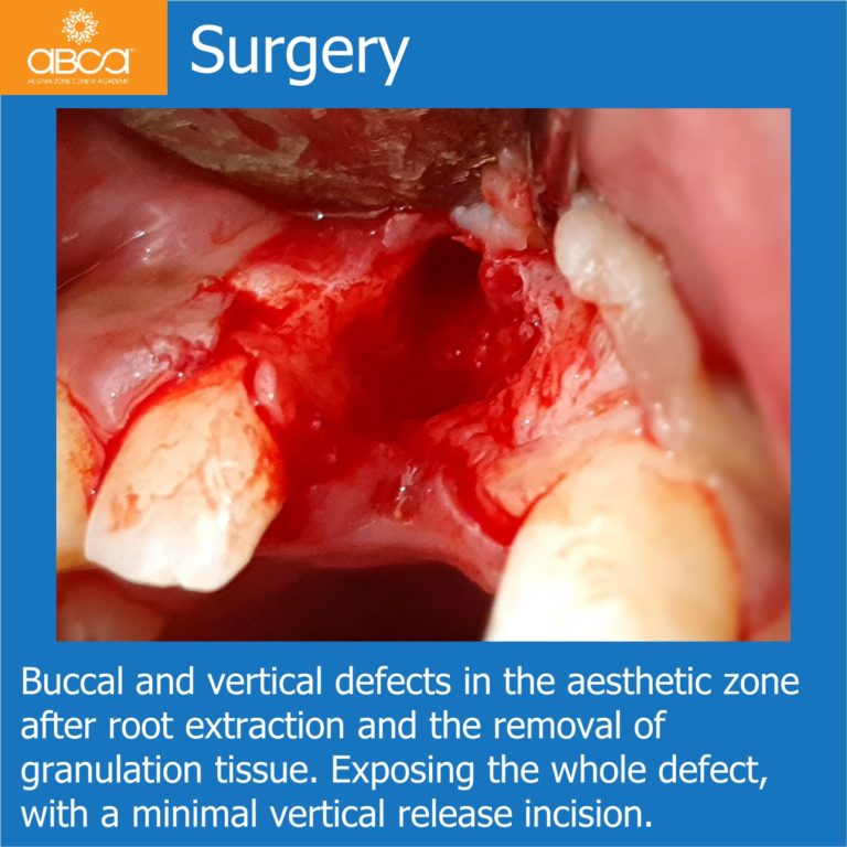 Implant and Augma in the Aesthetic Zone